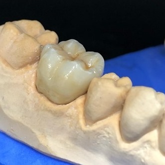 Imagen Prótesis Dentales e Implantes en Elche