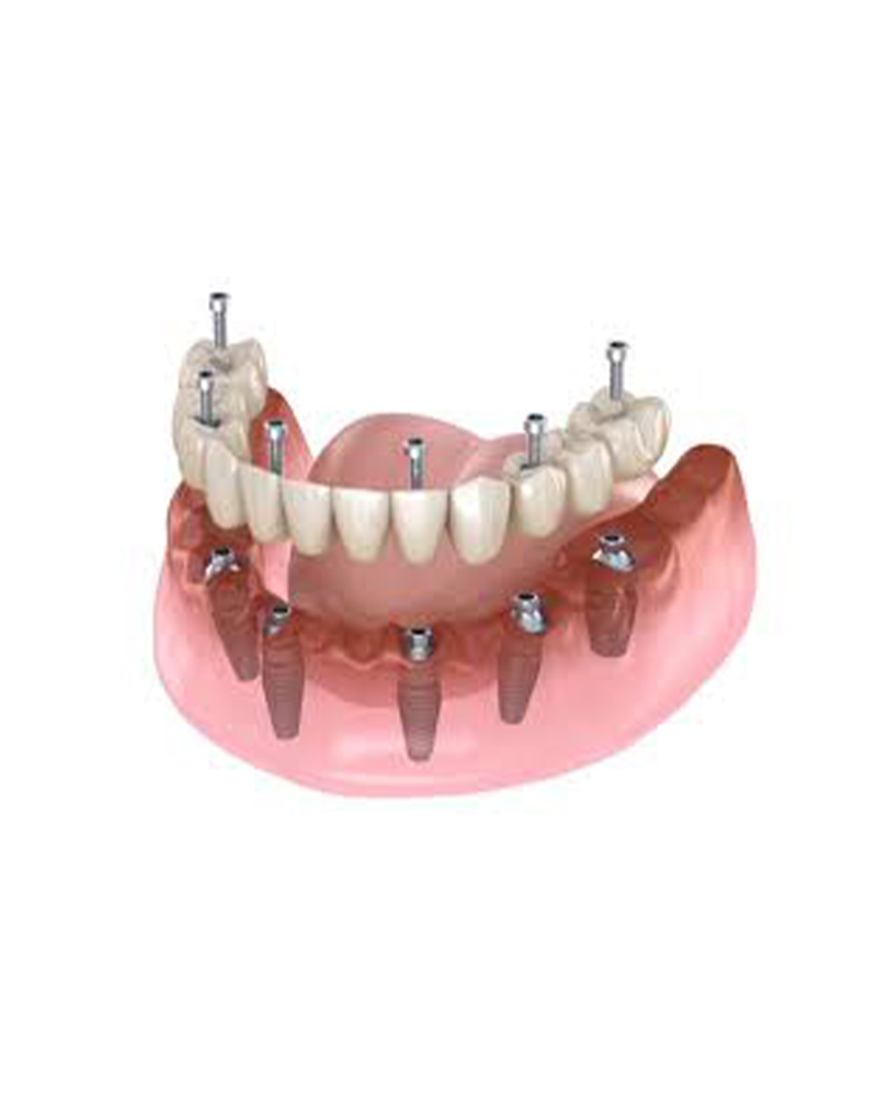 Imagen 2 Expertos en Prótesis Dentales desde 1990